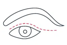 eyelids top scar new