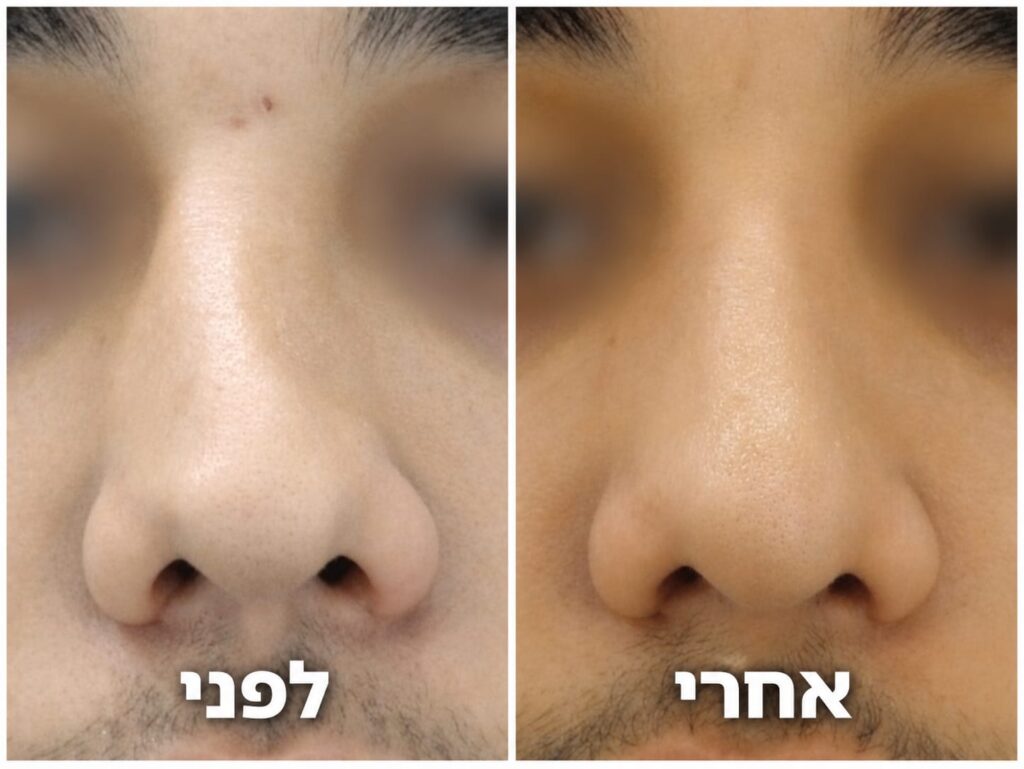תמונות לפני ואחרי ניתוח אף מתקן עם סחוסי צלע בידי ד״ר צח שרוני