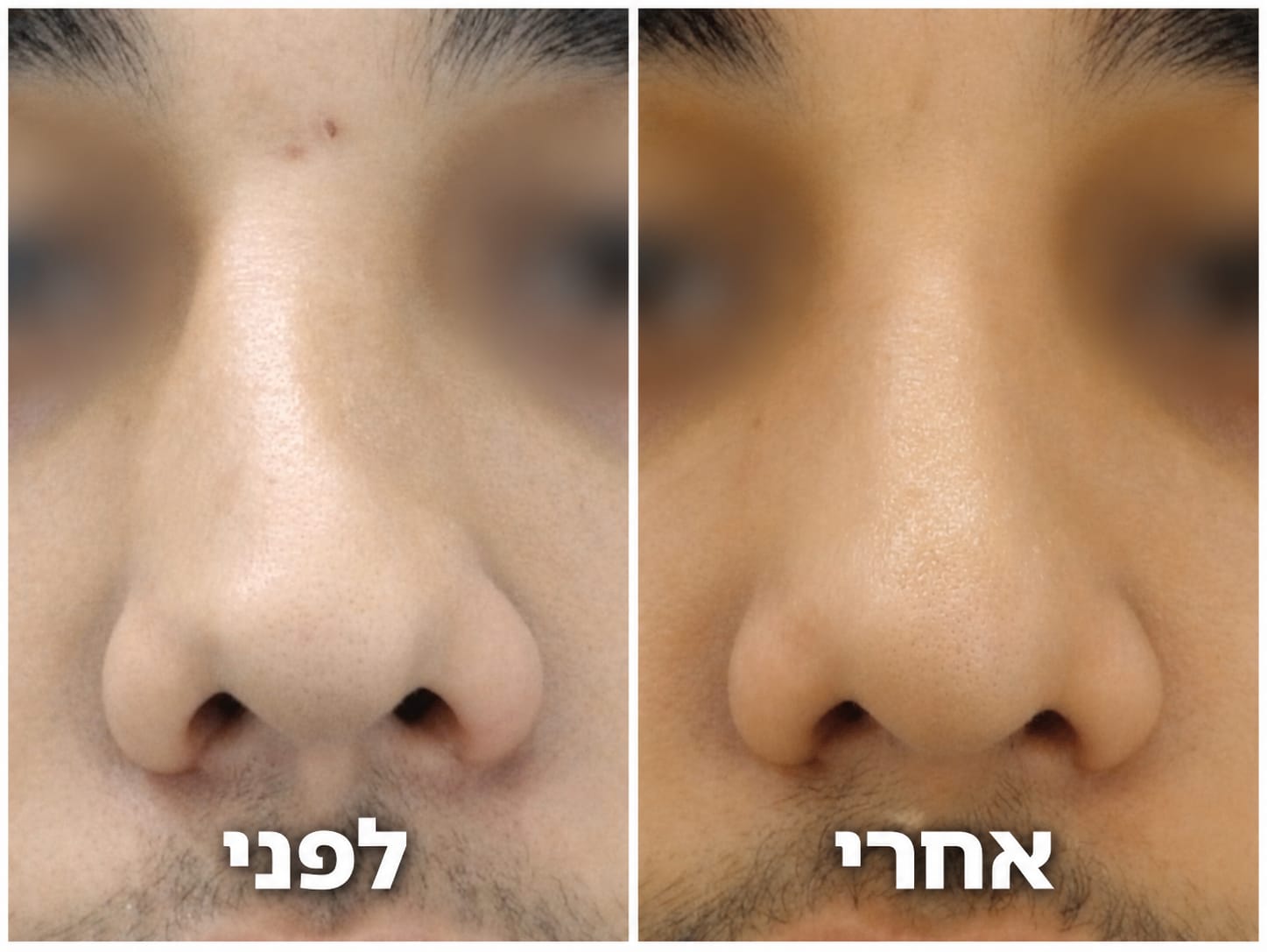 תמונות לפני ואחרי ניתוח אף מתקן עם סחוסי צלע בידי ד״ר צח שרוני