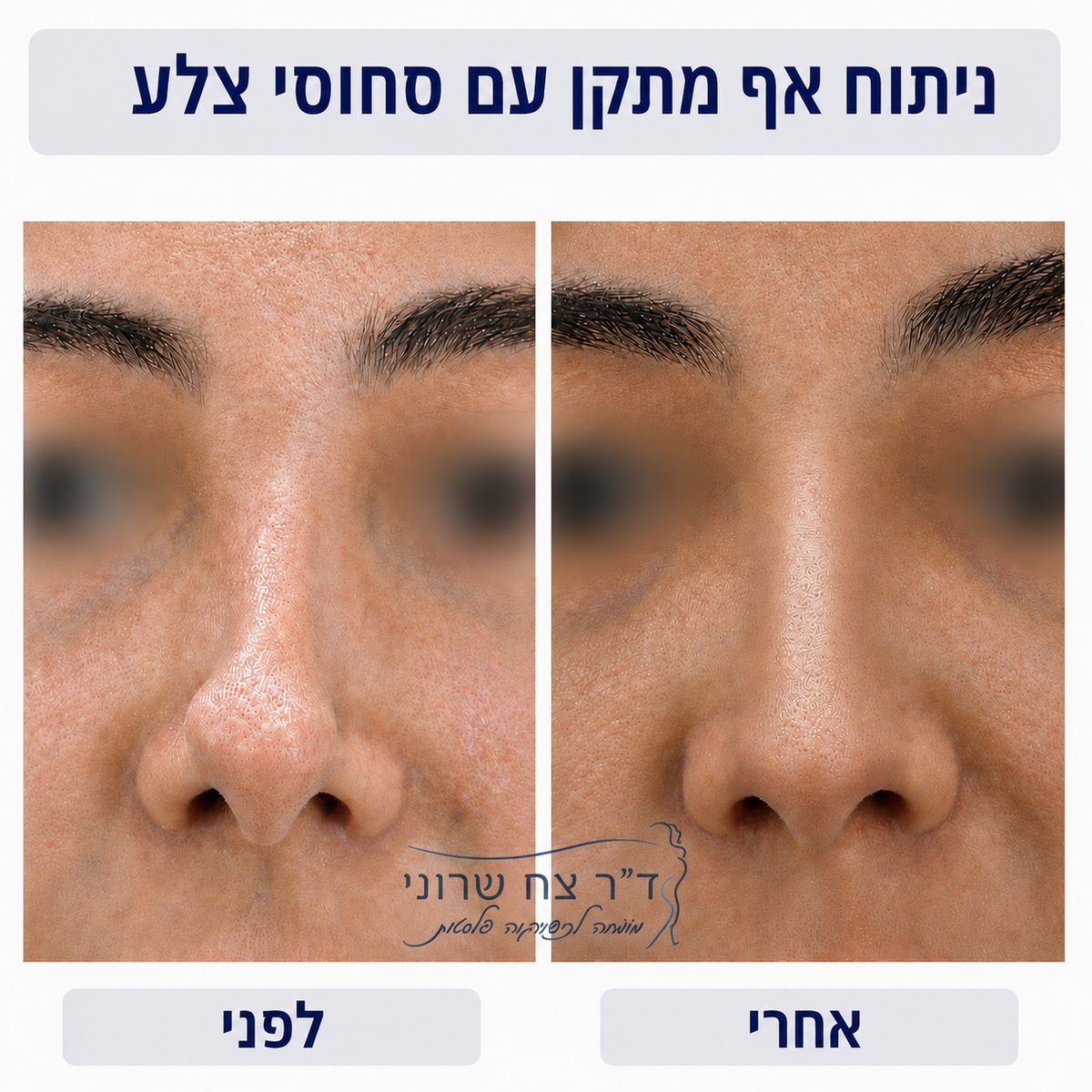 ניתוח אף מתקן עם סחוסי צלע, לפני ואחרי