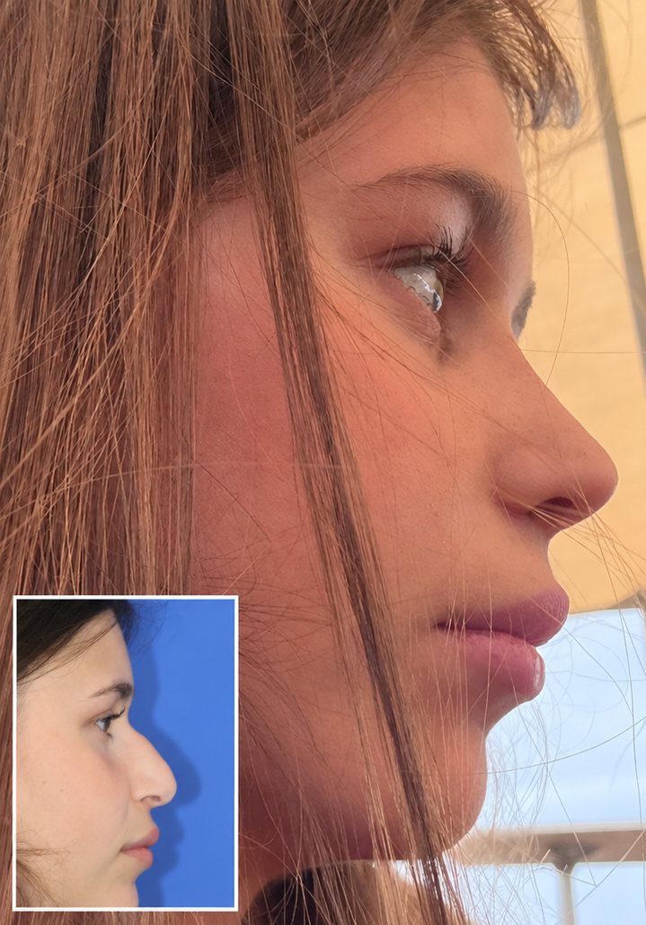 תוצאת ניתוח אף בשיטה הפתוחה ובפייאזו, פרופיל לפני ואחרי